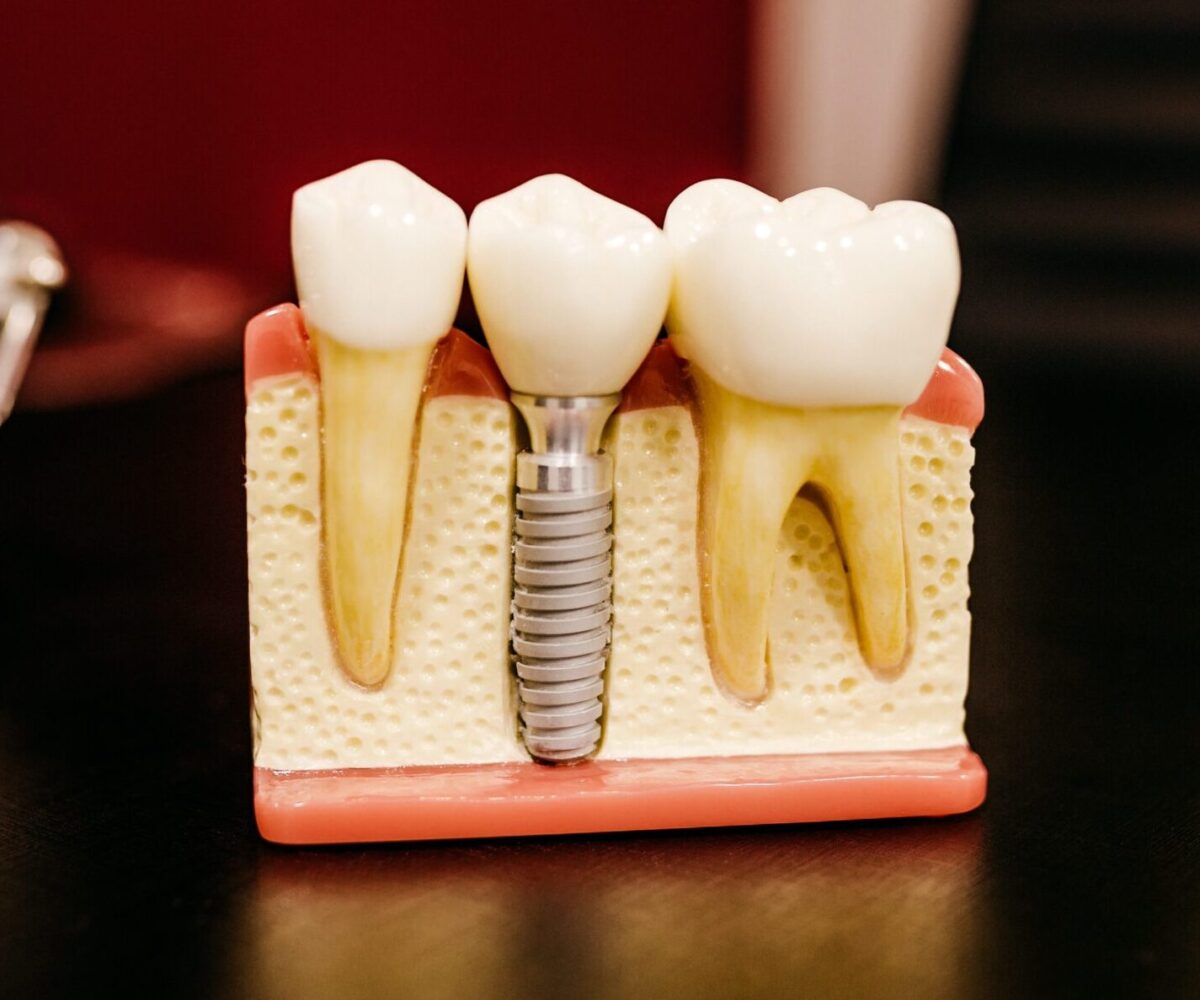 Rediscover your smile with long-lasting dental implants.